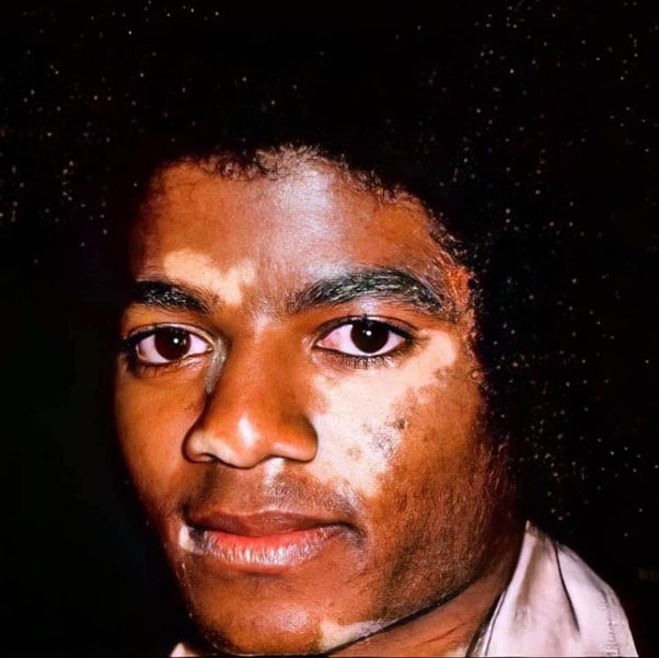michael jackson vitiligo